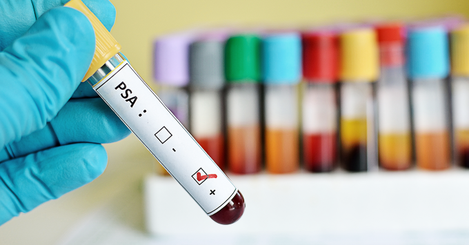 Как се диагностицира ракът на простатата?