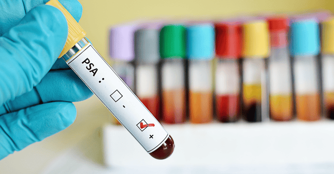 BG-Prostate-cancer-Как-се-диагностицира-ракът-на-простатата BG-Prostate-cancer-Как-се-диагностицира-ракът-на-простатата