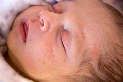 small-dengue-fever