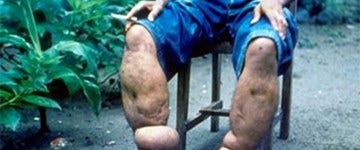 Filariasis