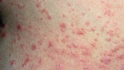 Example of guttate or drop psoriasis