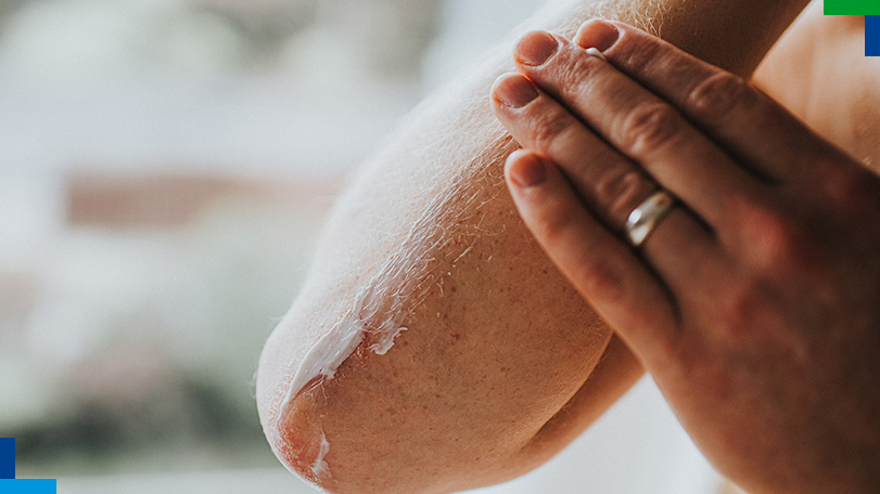 A person is putting cream on his psoriasis