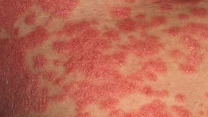 Example of erythrodermic psoriasis