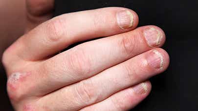 Example of nail psoriasis