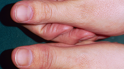 Example of psoriatic arthritis