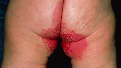 Example of inverse psoriasis