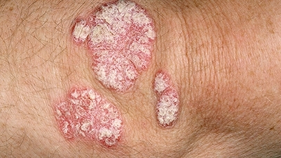Example of plaque psoriasis