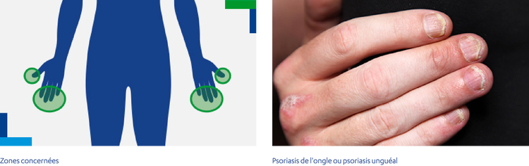 Psoriasis de l'ongle ou psoriasis unguéal