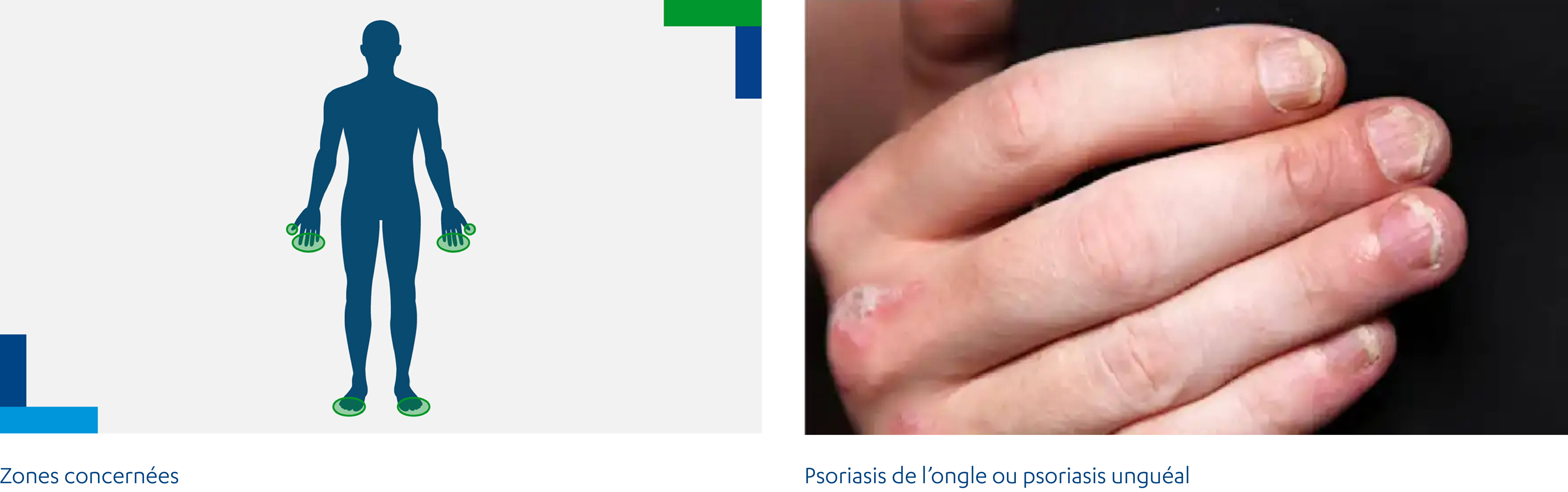 Psoriasis de l'ongle ou psoriasis unguéal