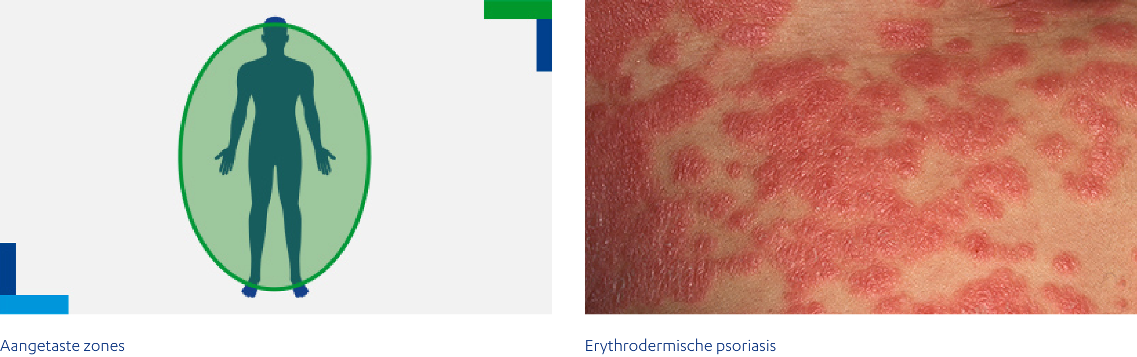Erythrodermische psoriasis