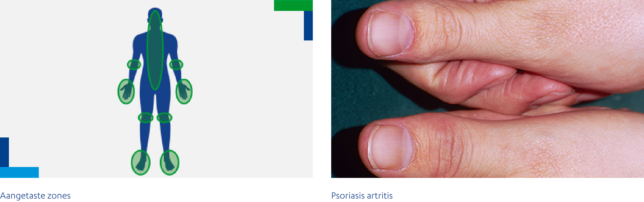 Psoriasis artritis kan mensen treffen met Pso