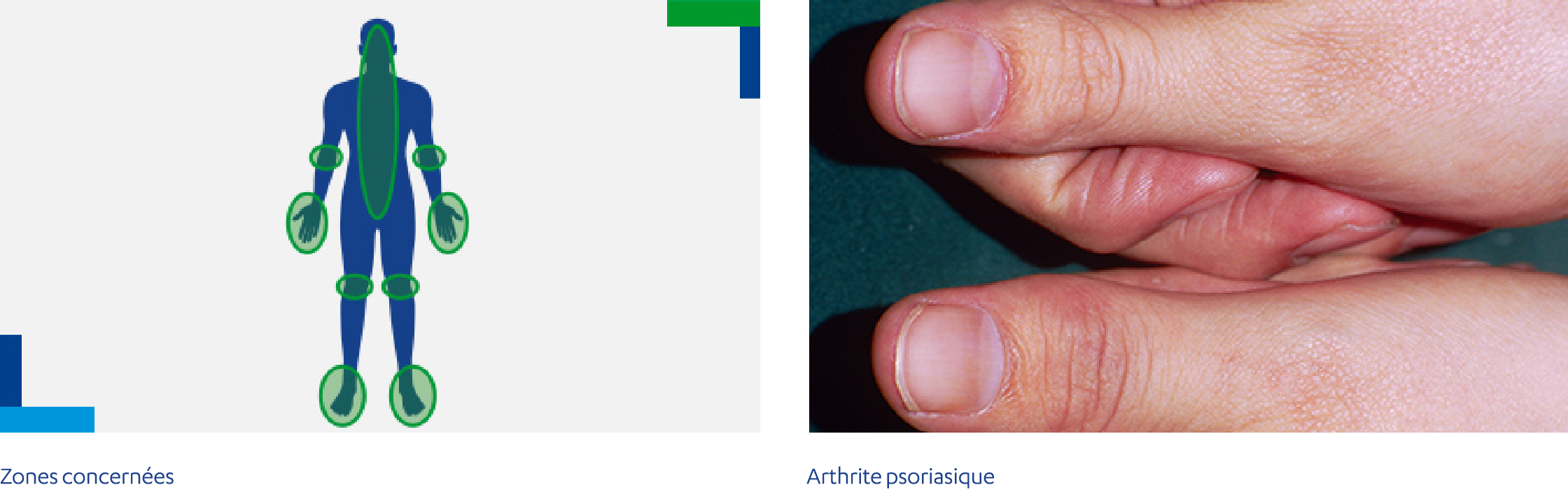 Arthrite psoriasique