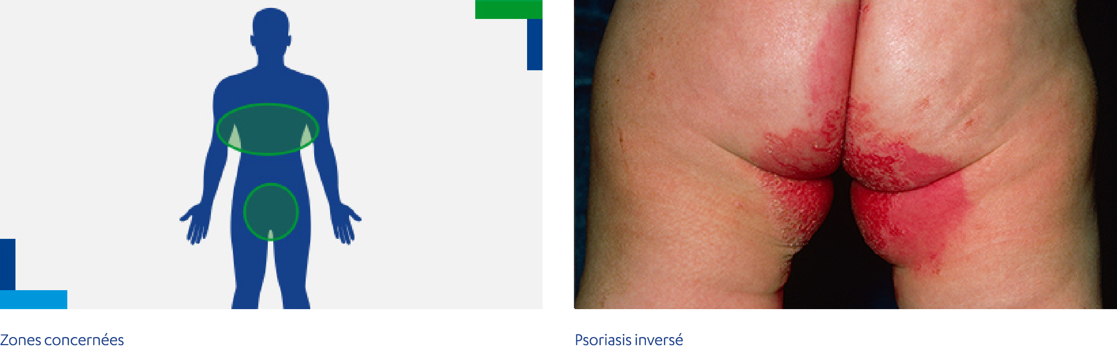 Psoriasis inversé