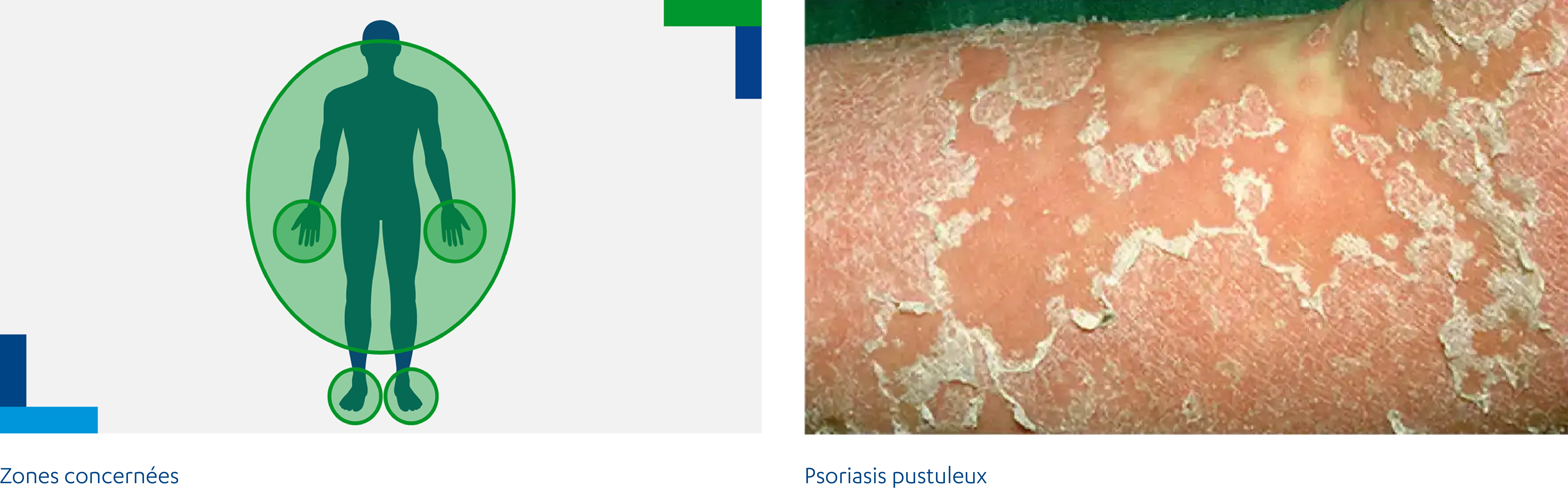 Psoriasis pustuleux