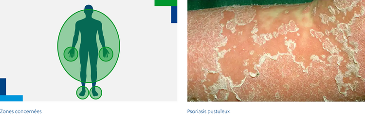 Psoriasis pustuleux Psoriasis pustuleux