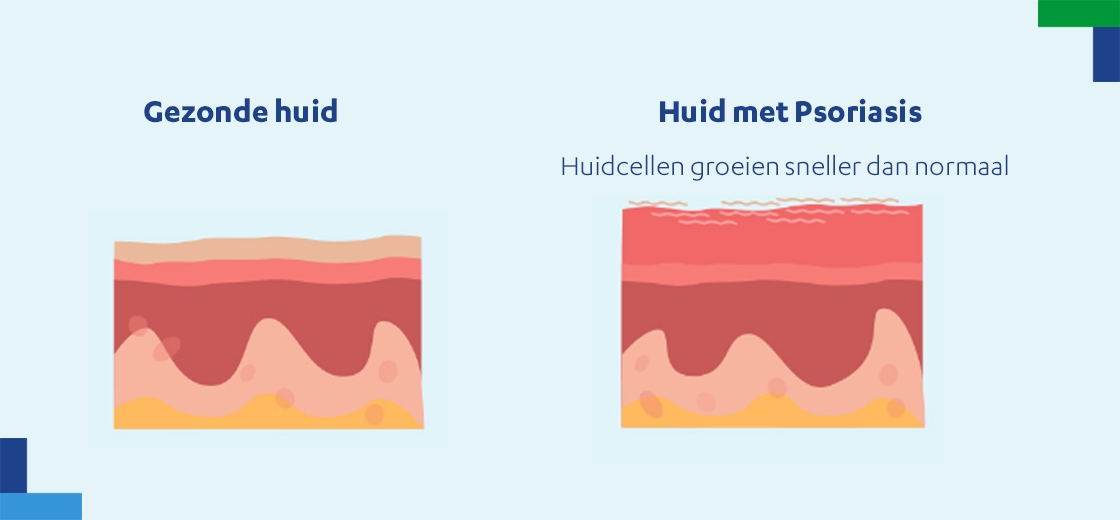 Zo werkt psoriasis