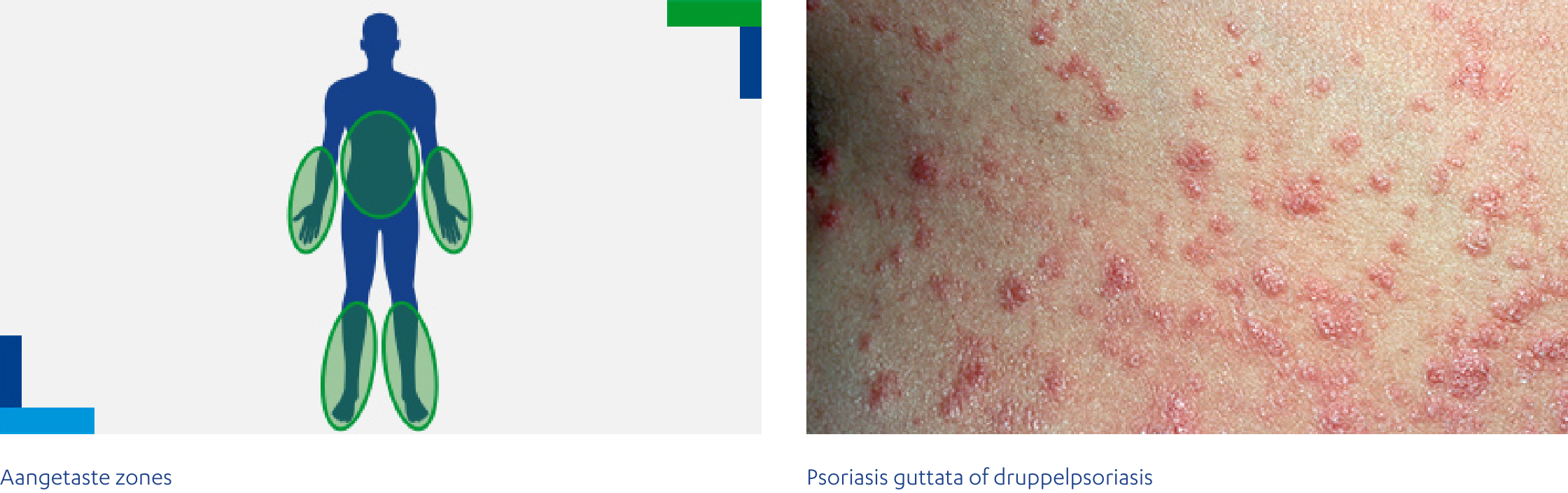 Psoriasis guttata of druppelpsoriasis