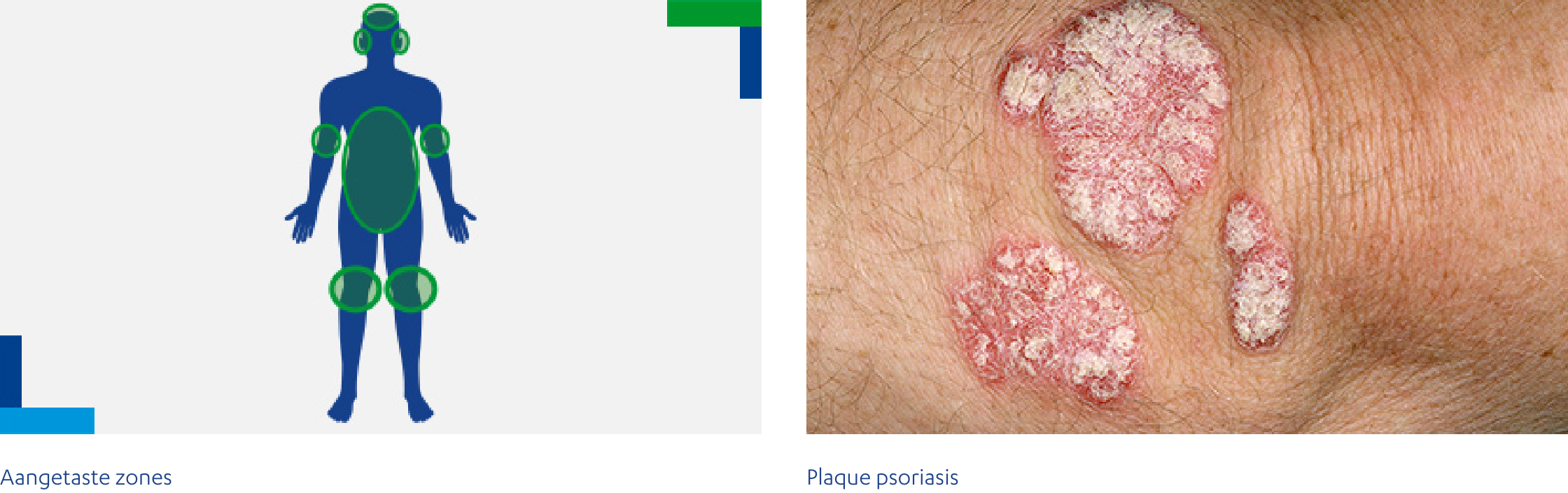 Plaque psoriasis