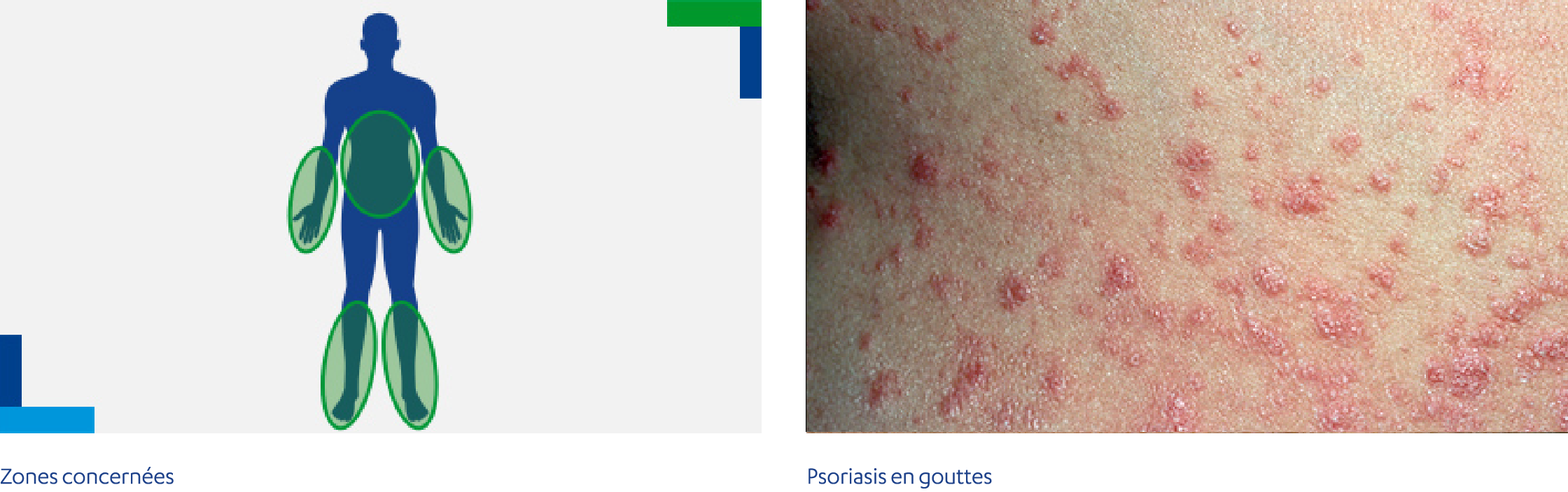 Psoriasis en gouttes