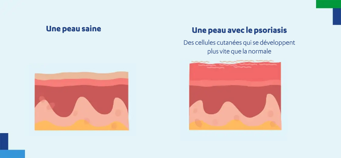 Comment fonctionne le psoriasis