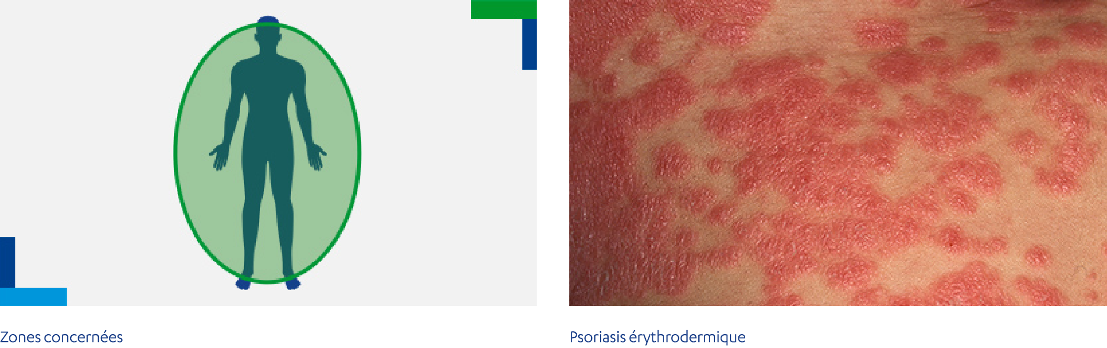 Psoriasis érythrodermique