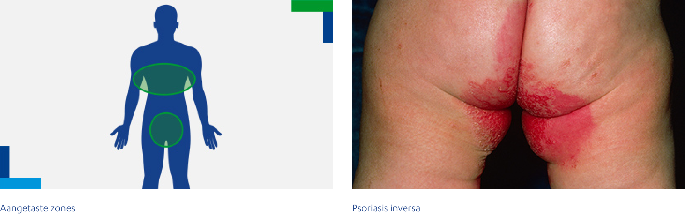 Psoriasis inversa