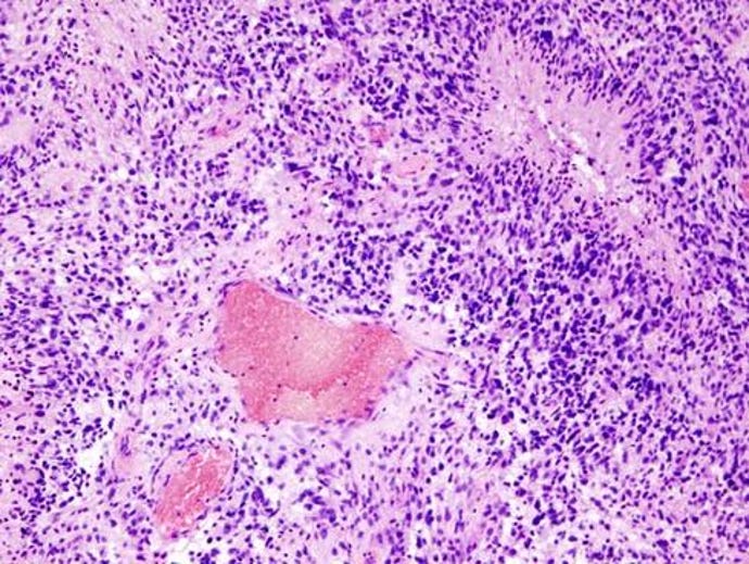 Glioblastoma.jpg