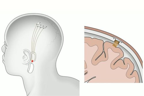 How to Sign Up for the Neuralink Human Trials