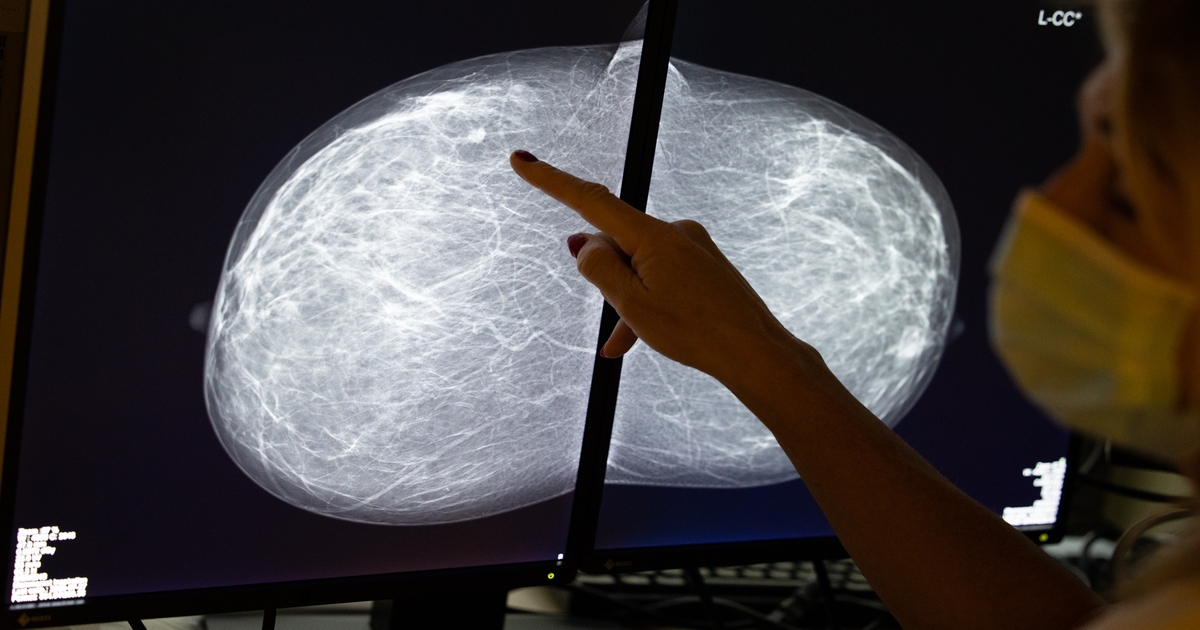 Google Licenses AI Tech for Breast Cancer Detection
