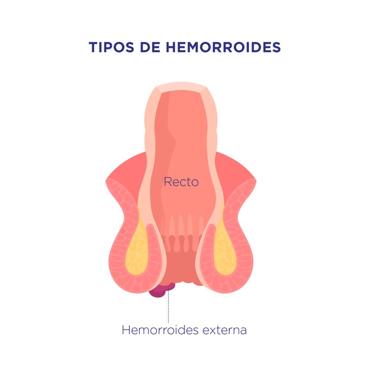 Hemorroides externas