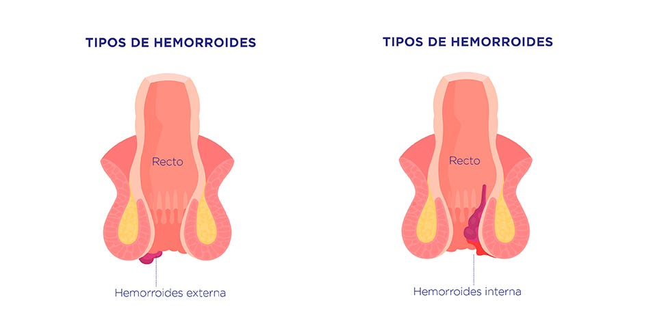 Cómo aliviar las hemorroides