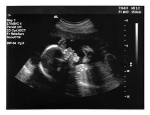Ultrasound image of an unborn child Ultrasound image of an unborn child