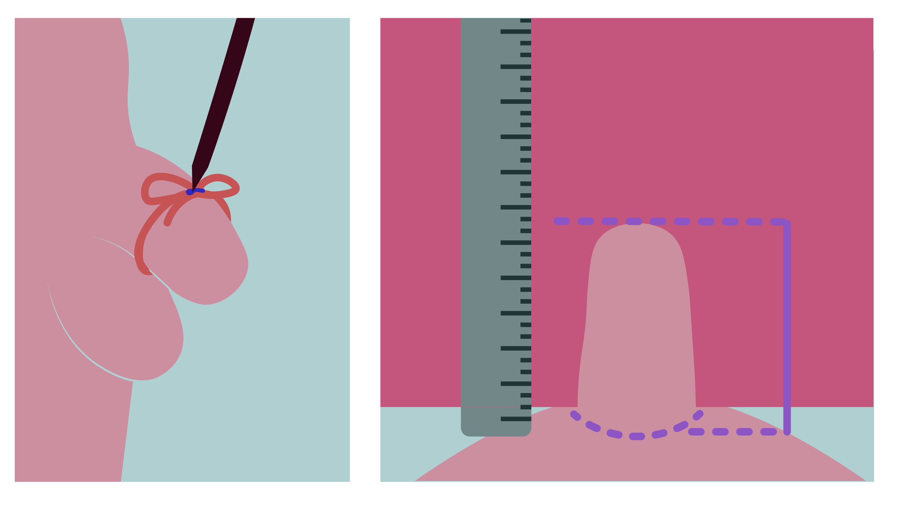 Une ficelle est nouée autour d'un pénis. Puis le pénis est placé à côté d'une règle.