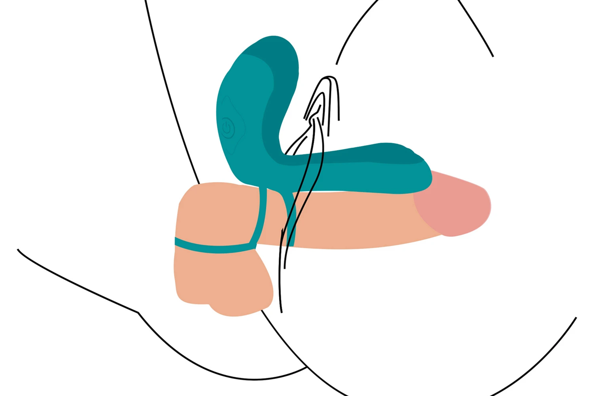 En illustration av en parvibrator i bruk