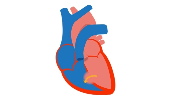 PAH ASSOCIATED WITH PREVALENT SYSTEMIC-TO-PULMONARY SHUNTS