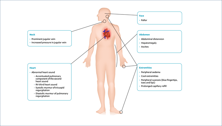 PAH-clinical-signs PAH-clinical-signs