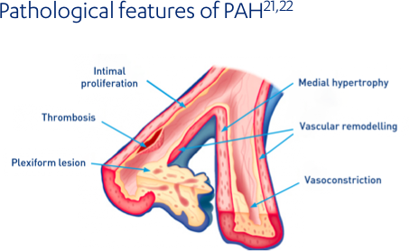 Pathological features of PAH