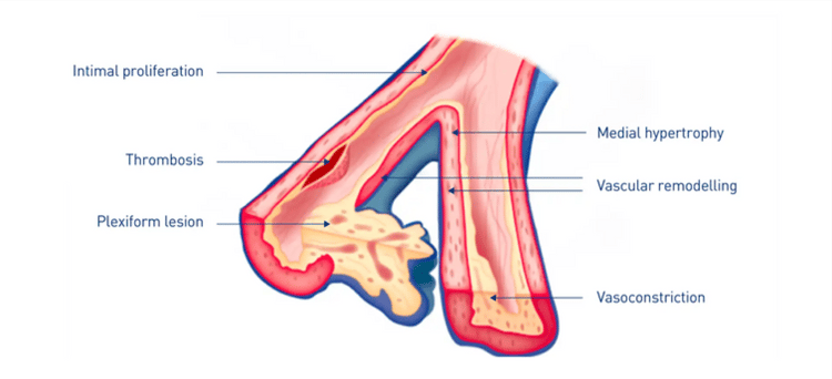 PAH-Histopathological-features PAH-Histopathological-features