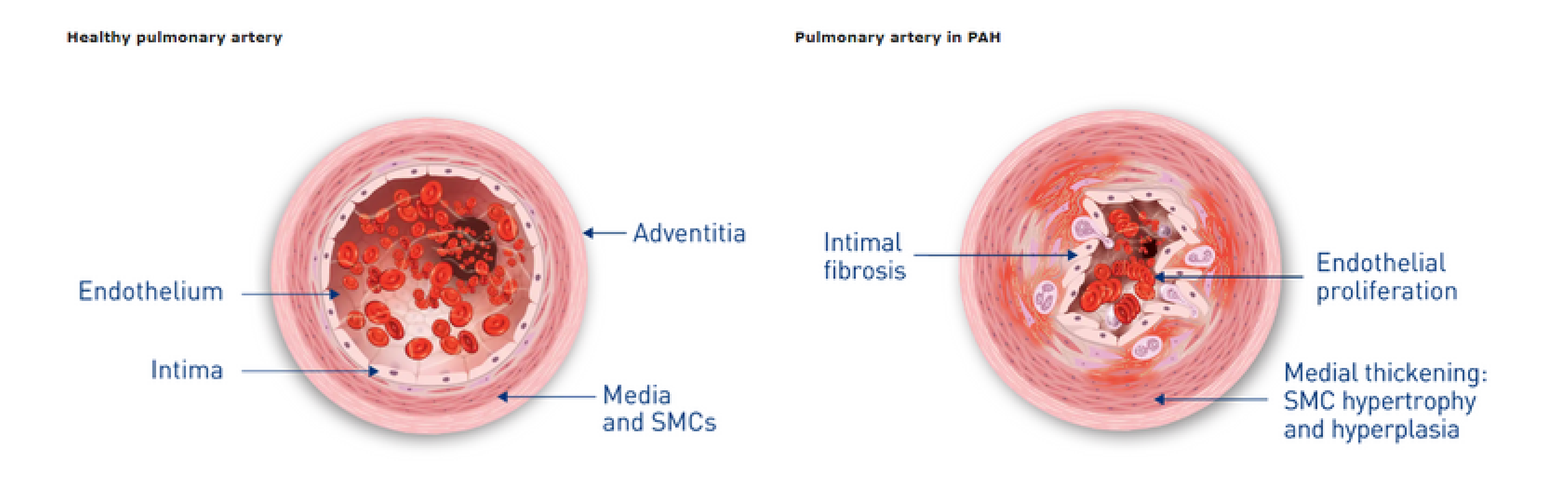 PAH Vascular remodelling