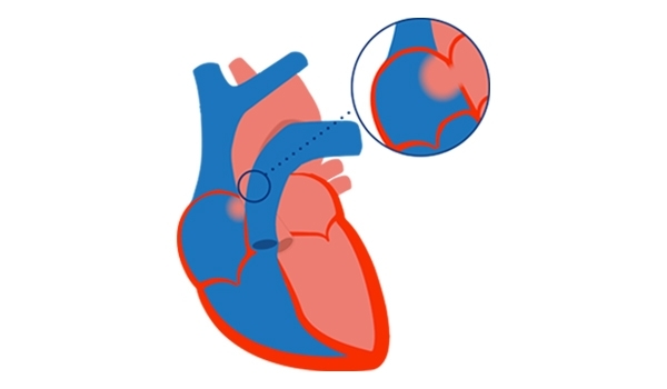 PAH WITH SMALL/COINCIDENTAL DEFECTS