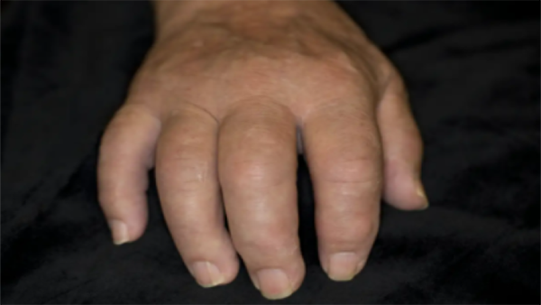 Δακτυλίτιδα