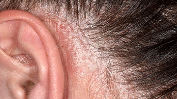 Ψωρίαση κατά πλάκας