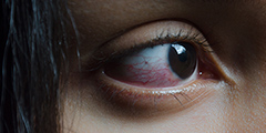 red-painful-eyes