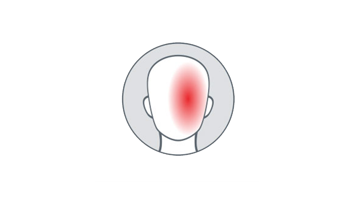 migraine