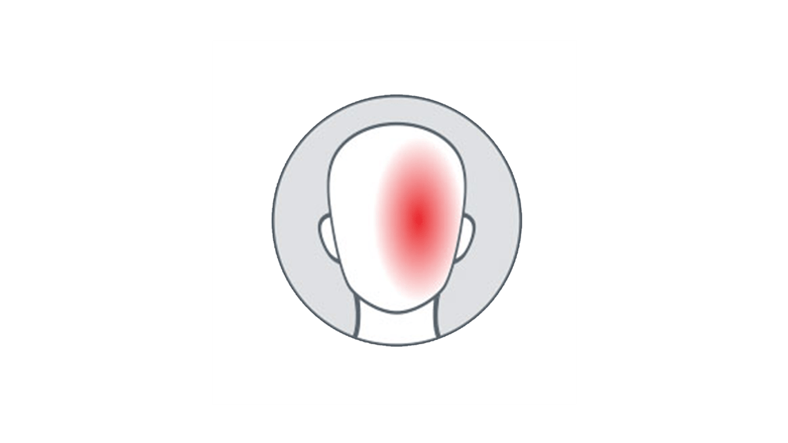 migraine