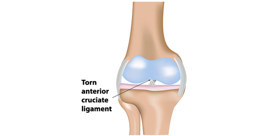ACL injury