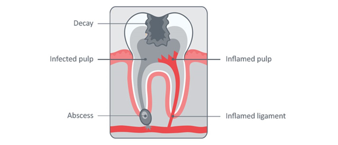 dental pain tooth
