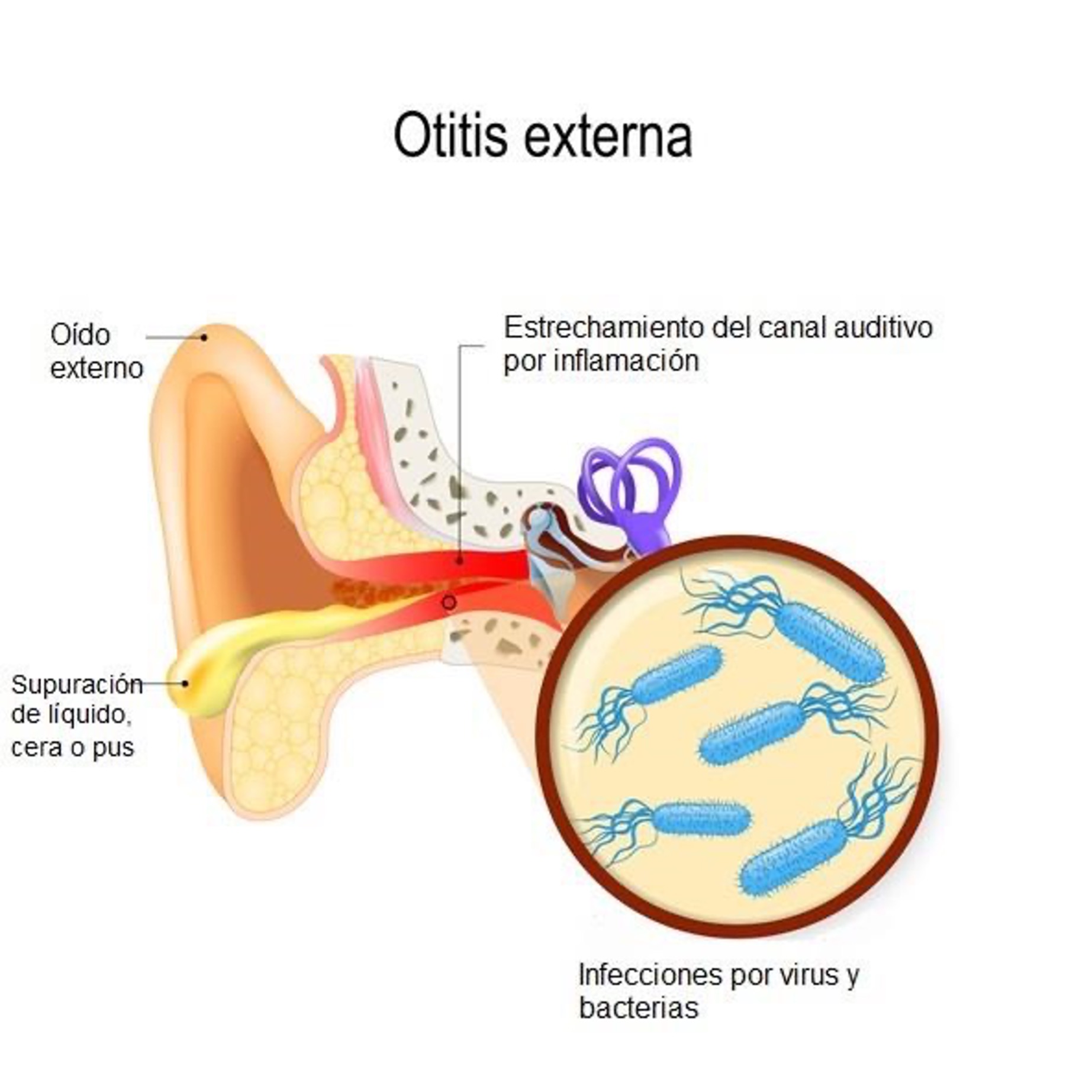Otitis externa