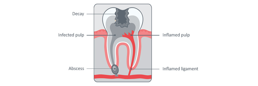 dental pain tooth