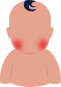 Does your baby have flushed or red cheeks?